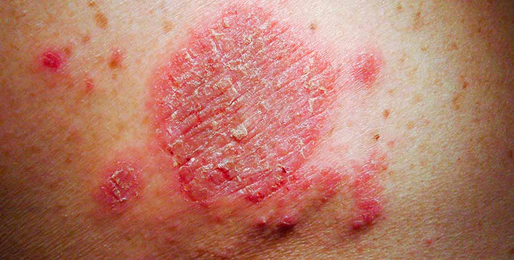 numularni-dermatitis